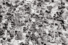multiple concretions